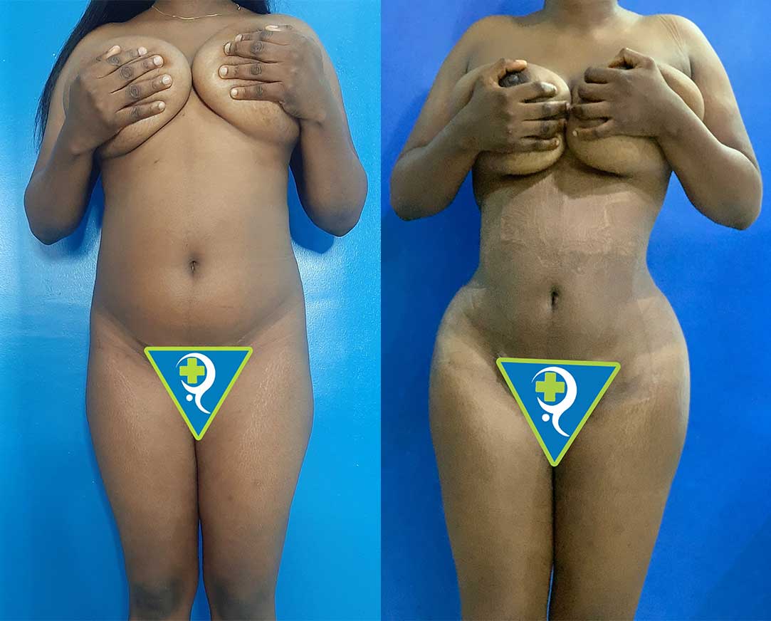 360-Liposuction-with-Fat-TRANSFER