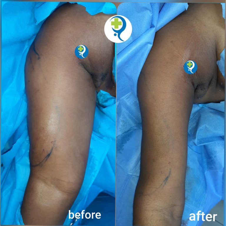 Liposuction-of-the-upper-arm