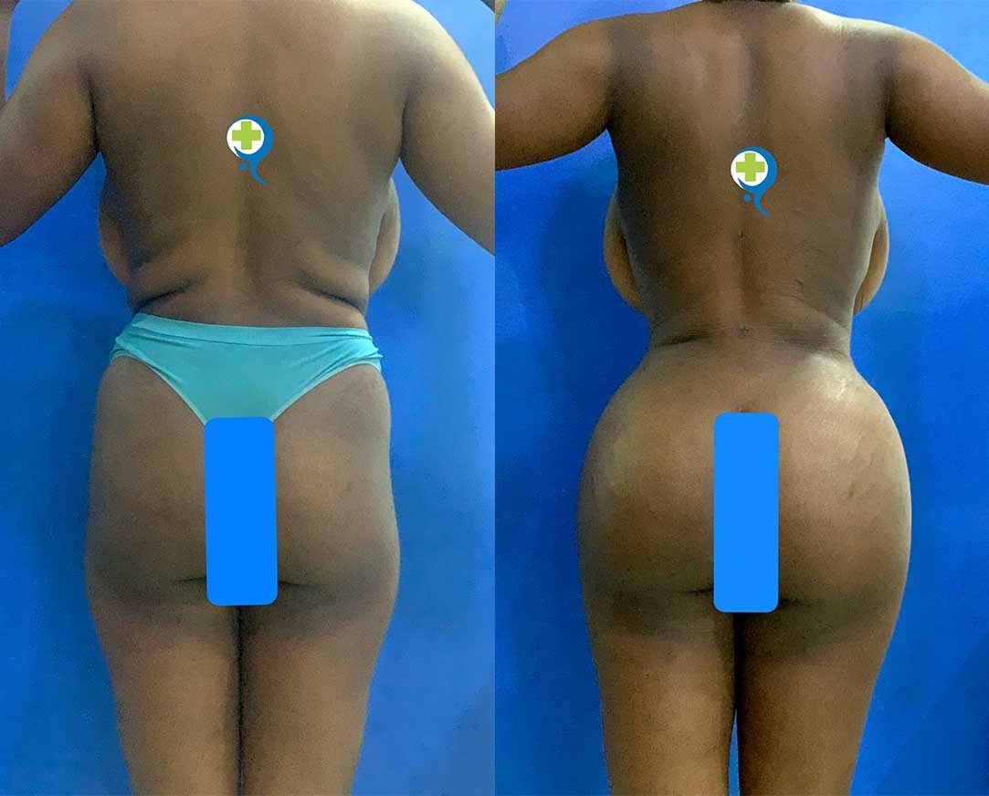 360-Liposuction-with-Brazilian-Butt-Lift