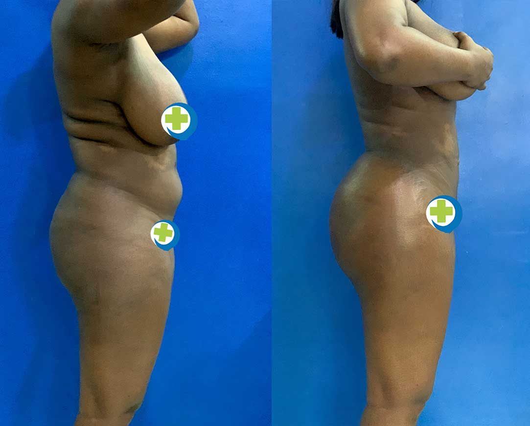 360-Liposuction-with-Fat-Transfer