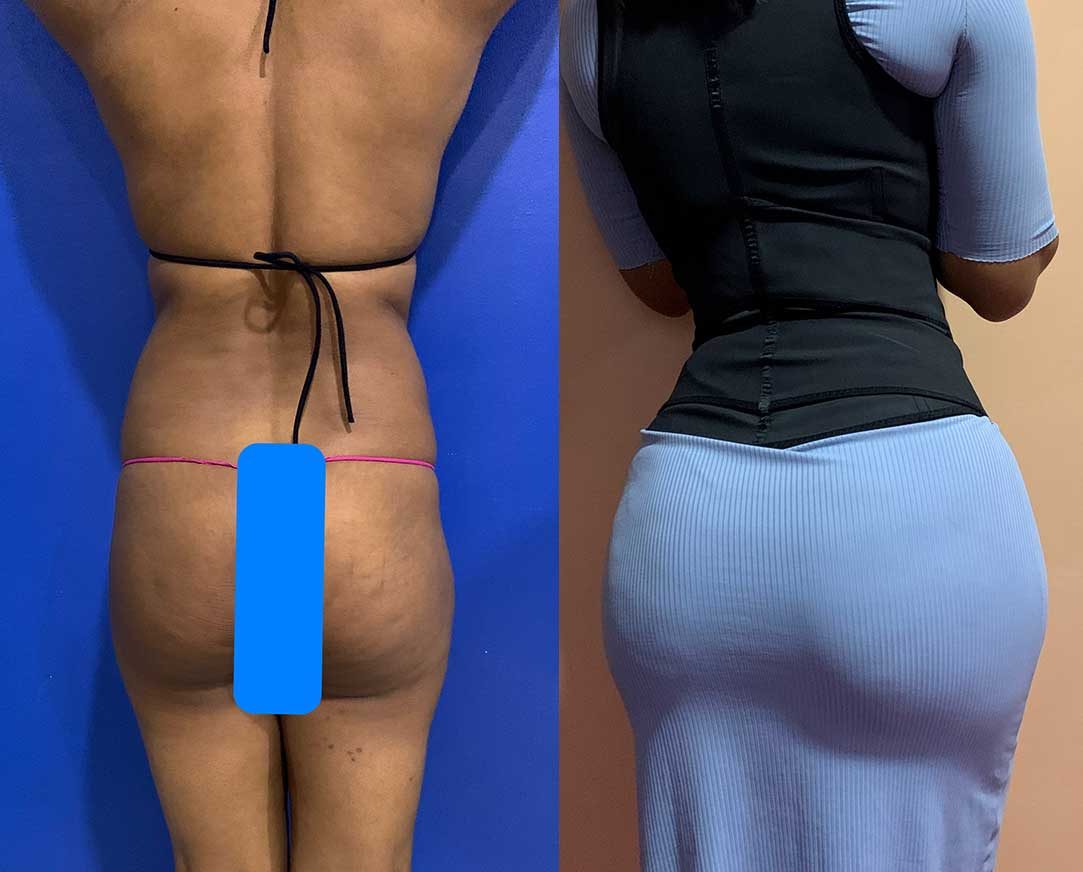 360-Liposuction-with-Fat-Transfer-to-the-hips-and-butt