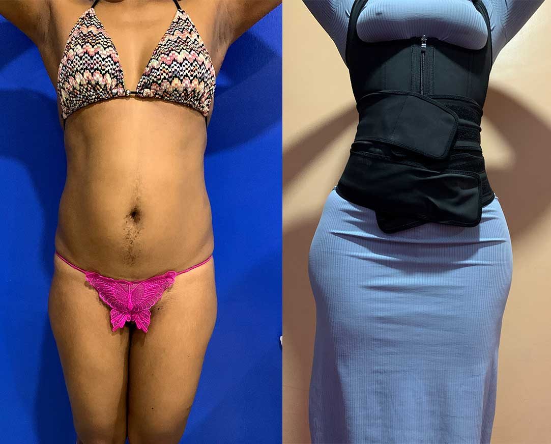 360-Liposuction-with-Fat-Transfer-to-the-hips-and-butt