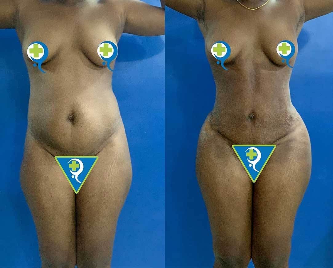 360-Liposuction-with-Mini-Tummy-Tuck
