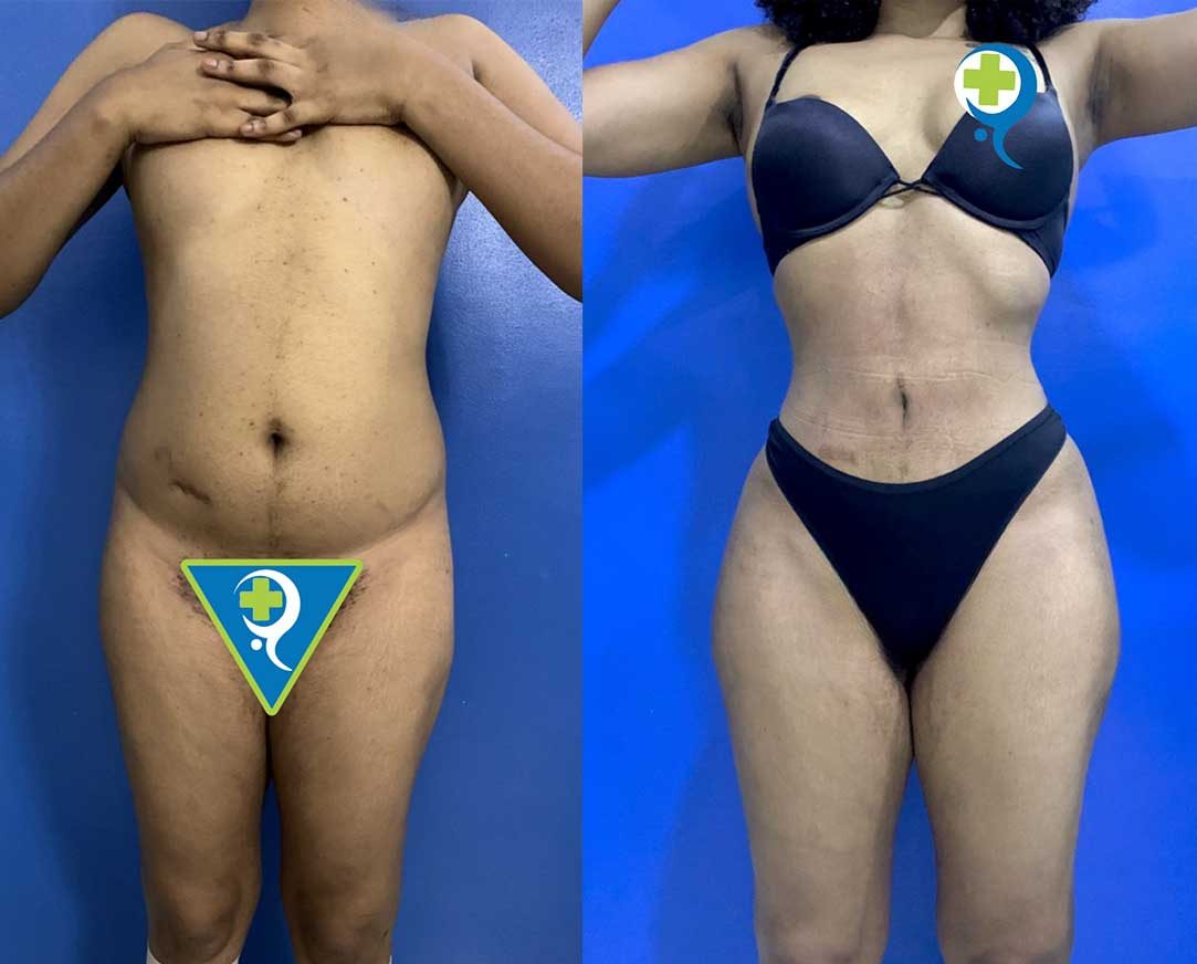6months-after-360-Liposuction-with-Fat-Transfer-to-the-hips-and-butt