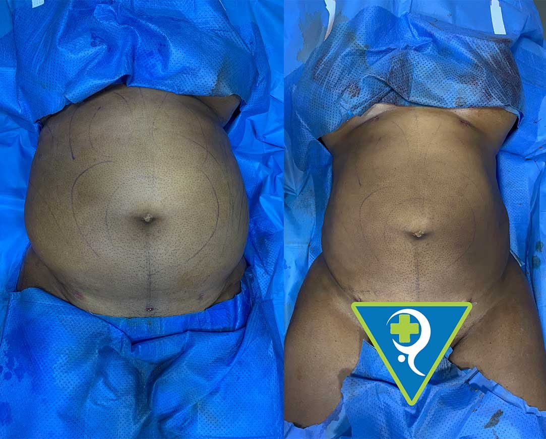 Liposuction-of-the-Tummy
