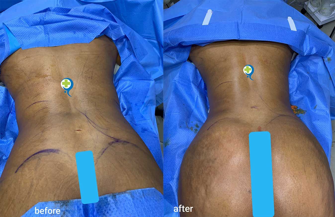Liposuction-with-Fat-Transfer-to-the-Hips-and-Butt